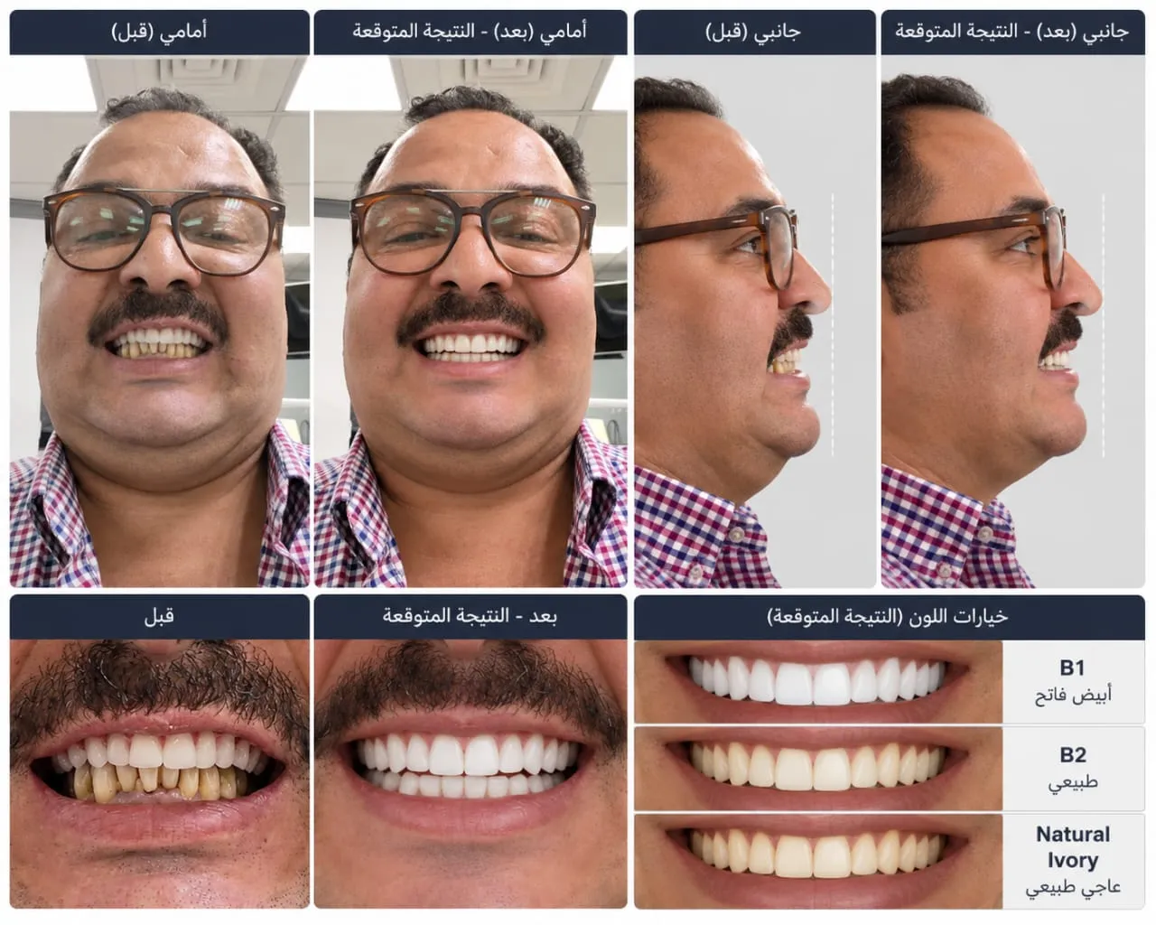 معاينة تصميم ابتسامة من الدكتور نبيل: الابتسامة قبل العلاج، والابتسامة الجديدة التي صمّمها الدكتور نبيل من الأمام والجانب مع ثلاثة خيارات للون